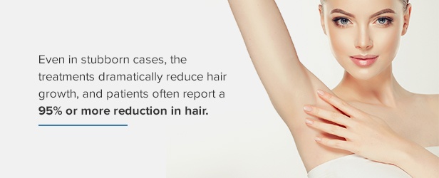 laser hair removal often has 95% more more reduction in hair