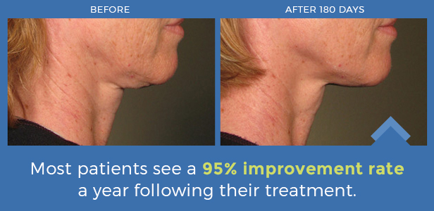 Stats for how much improvement patients see after a year of treatments