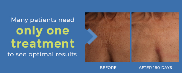 many patients need only one treatment to see best results before and after