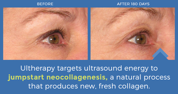 before and after of Ultherapy treatment on eyelids