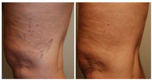 spider veins before and after