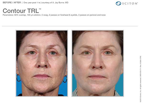 before and after laser resurfacing treatment for woman