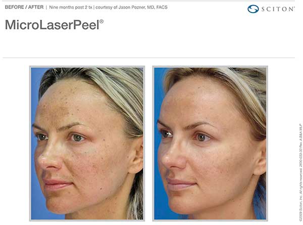 before and after Micro Laser Peel