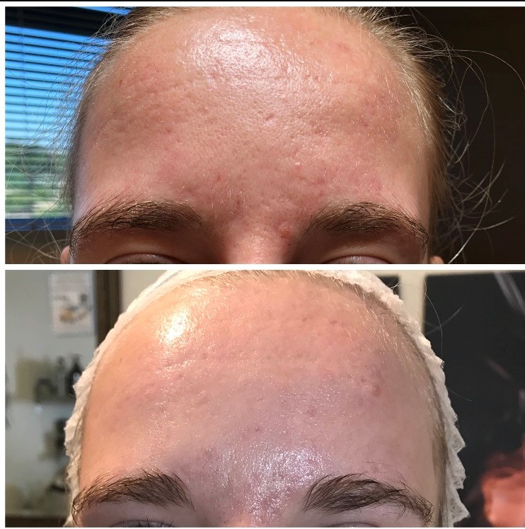 before and after microneedling