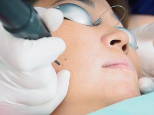 patient receiving laser hair removal