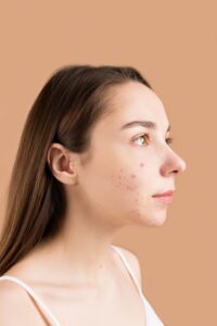 woman with acne on her face
